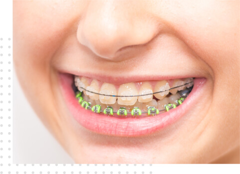 invisible-teeth-braces-in-chennai