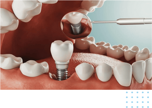 dental-implants-in-chennai
