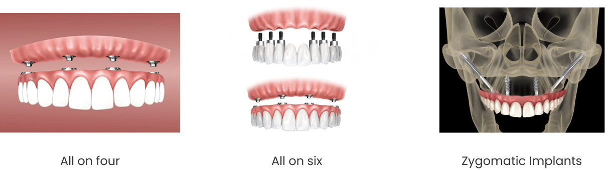 dental-implants-cost-in-kilpauk
